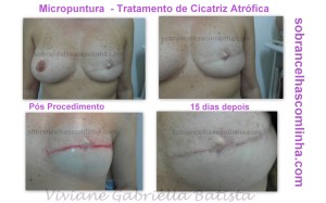 micropuntura em cicatriz